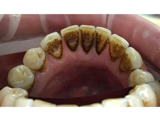 До професійної гігієни