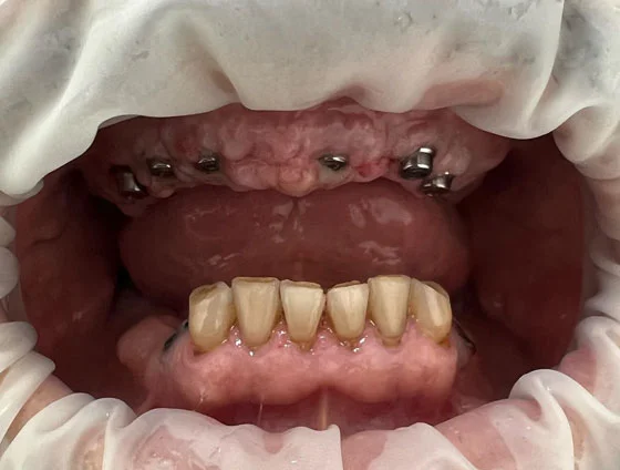 До імплантації зубів