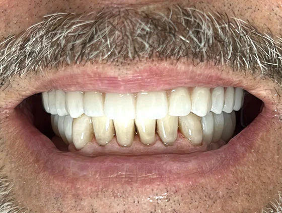 Після імплантації зубів