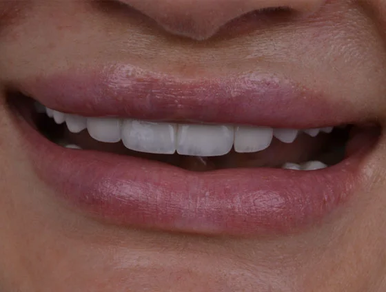 Після встановлення керамічних вінірів – кейс 1