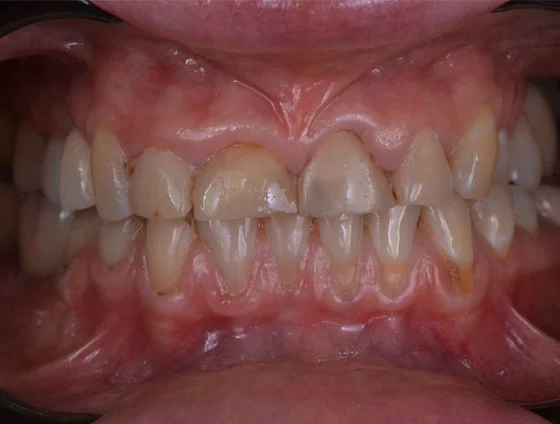 До встановлення керамічних вінірів – кейс 2