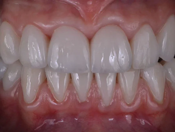 Після встановлення керамічних вінірів – кейс 2