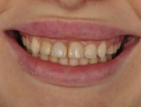 До комплексної реабілітації усмішки – кейс 4