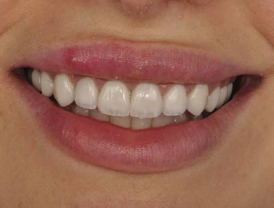 Після комплексної реабілітації усмішки – кейс 4
