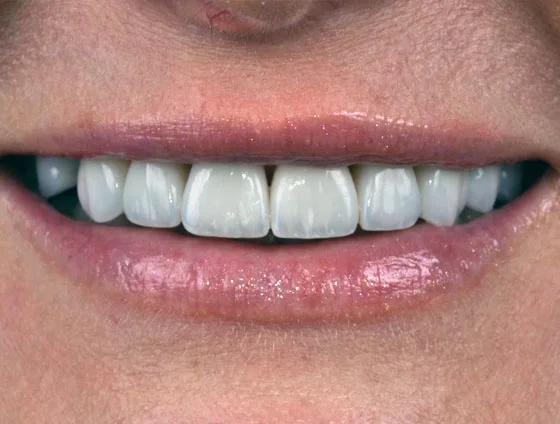 Після встановлення керамічних вінірів – кейс 5