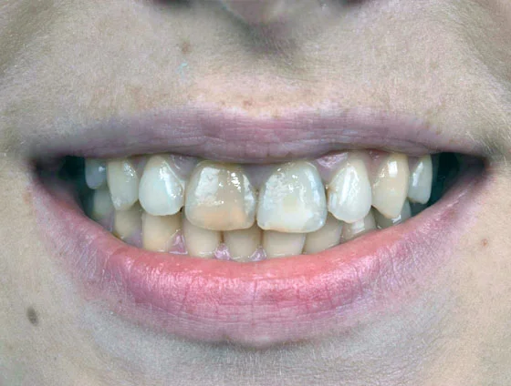 До естетичної реабілітації керамічними вінірами – кейс 6