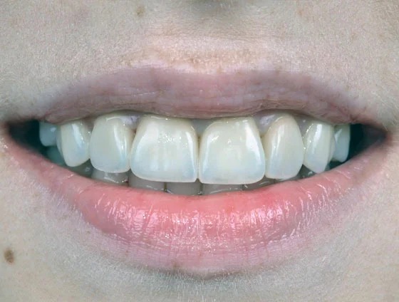 Після естетичної реабілітації керамічними вінірами – кейс 6
