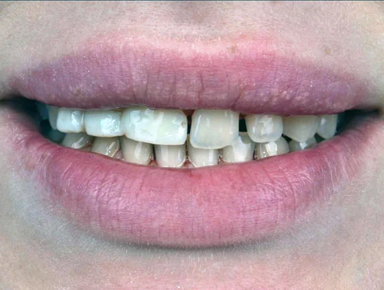 До комплексної реабілітації усмішки – кейс 7