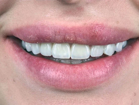 Після комплексної реабілітації усмішки – кейс 7