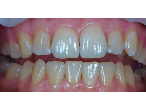 До відбілювання зубів